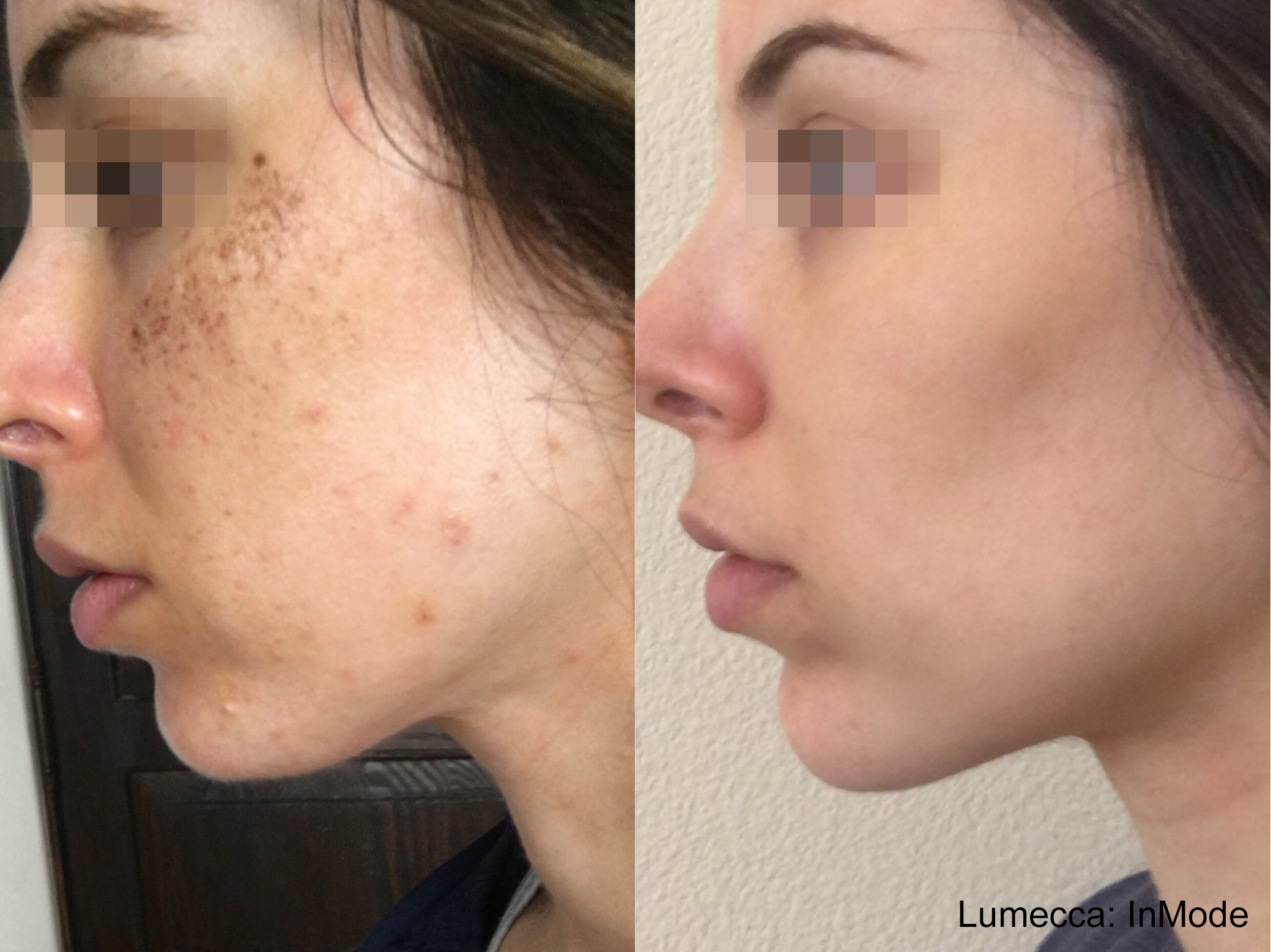 Nashville acne treatment