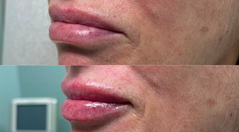 Nashville dermal fillers